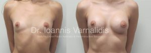αυξητικη στηθους breast augmentation θεσσαλονικη